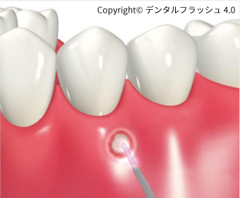 口内炎・口角炎治療