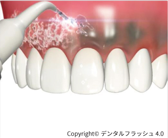 知覚過敏治療